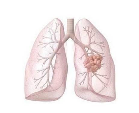 【可切除非小细胞肺癌围手术期治疗】SHR-1316注射液临床招募