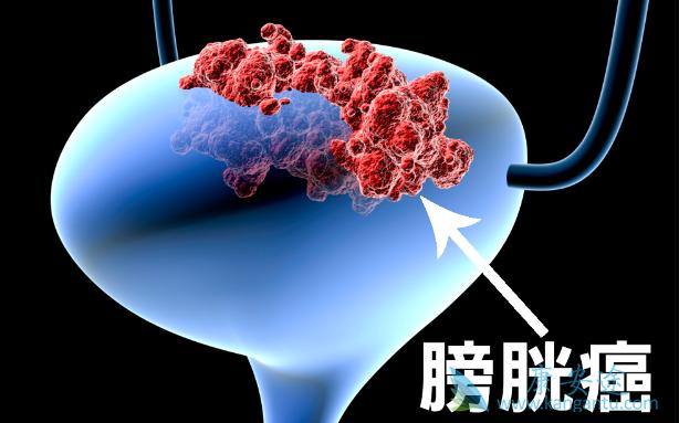 靶向药物厄达替尼Erdafitinib使部分晚期膀胱癌患者受益