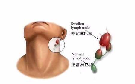 注意：T细胞淋巴瘤可能被误诊！