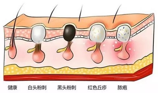 使用克拉考特酮要注意什么？